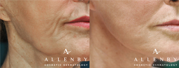 CO2 & Profound Before and After Photo by Allenby Cosmetic Dermatology in Delray Beach, FL