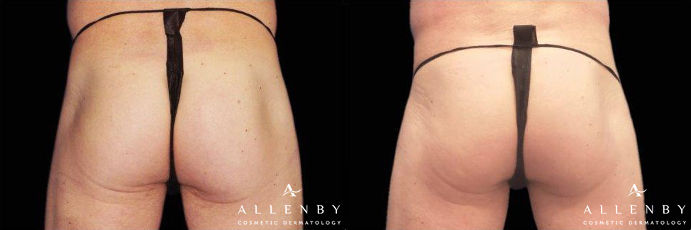 EMSCULPT Before and After Photo by Allenby Cosmetic Dermatology in Delray Beach, FL