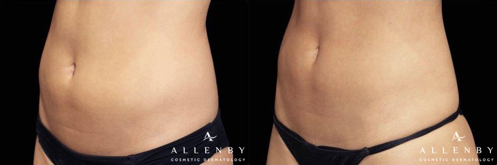 EMSCULPT Before and After Photo by Allenby Cosmetic Dermatology in Delray Beach, FL