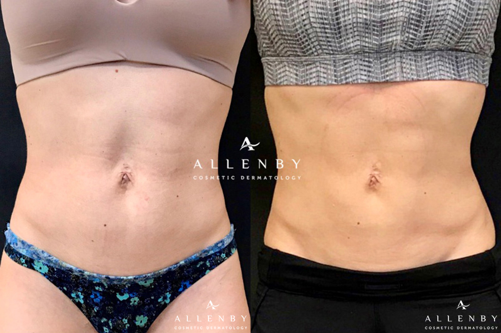 CoolSculEMSCULPT Before and After Photo by Allenby Cosmetic Dermatology in Delray Beach, FLpting Before and After Photo by Allenby Cosmetic Dermatology in Delray Beach, FL