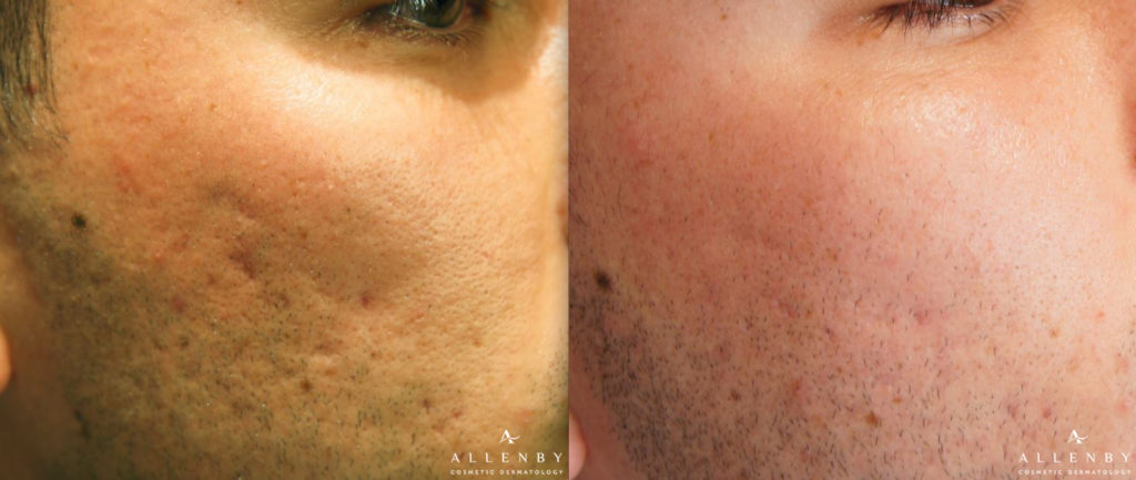 Microneedling with Radio Frequency Before and After Photo by Allenby Cosmetic Dermatology in Delray Beach, FL