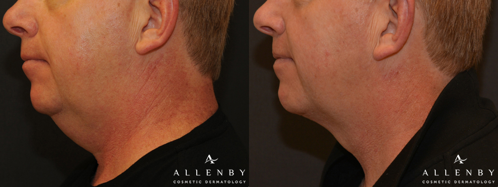 Kybella Before and After Photo by Allenby Cosmetic Dermatology in Delray Beach, FL