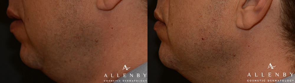 Chin Filler Before and After Photo by Allenby Cosmetic Dermatology in Delray Beach, FL