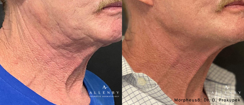 Morpheus8 Before and After Photo by Allenby Cosmetic Dermatology in Delray Beach, FL