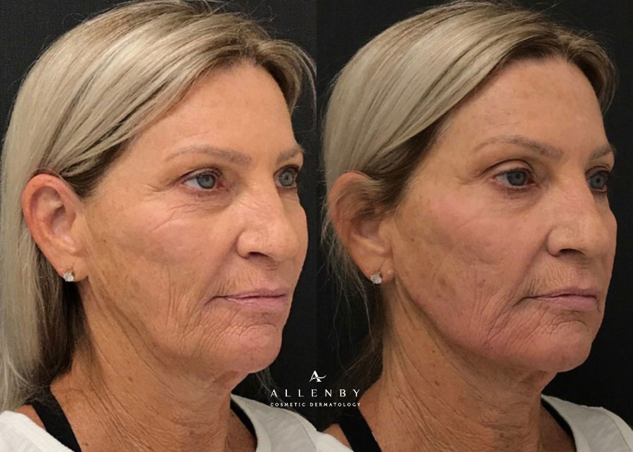 Cheek Filler, Jaw Line Filler Before and After Photo by Allenby Cosmetic Dermatology in Delray Beach, FL