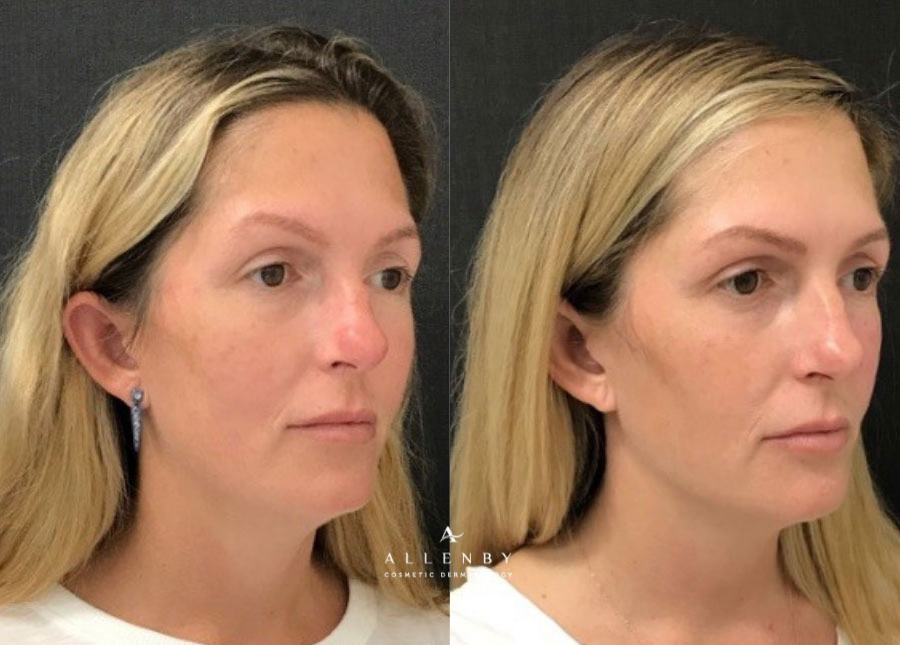 Cheek Filler Before and After Photo by Allenby Cosmetic Dermatology in Delray Beach, FL