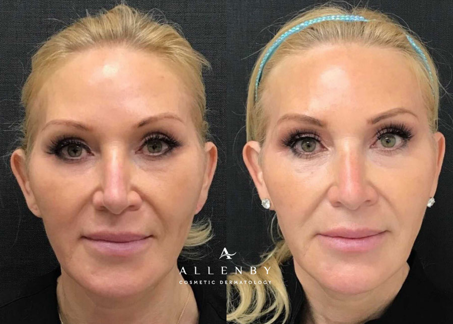 European Peel Before and After Photo by Allenby Cosmetic Dermatology in Delray Beach, FL