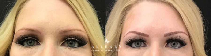 Microblading Before and After Photo by Allenby Cosmetic Dermatology in Delray Beach, FL