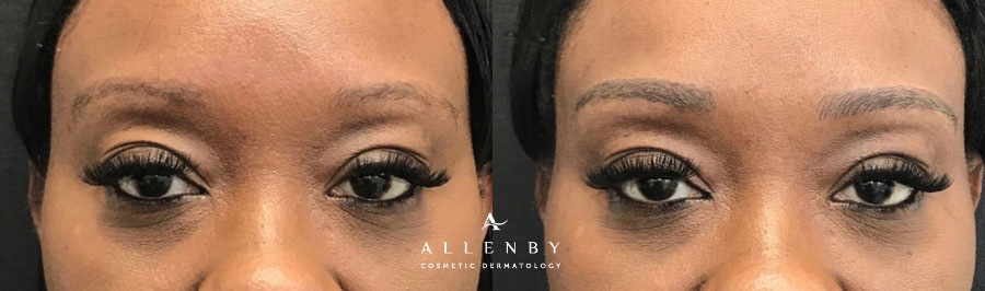 Microblading Before and After Photo by Allenby Cosmetic Dermatology in Delray Beach, FL