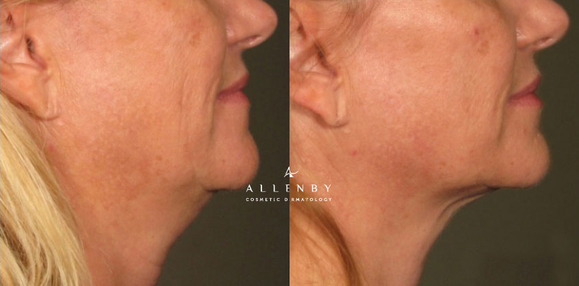 Ultherapy Before and After Photo by Allenby Cosmetic Dermatology in Delray Beach, FL