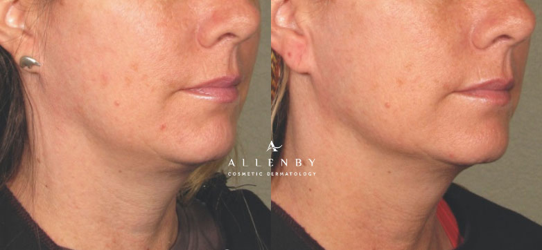 Ultherapy Before and After Photo by Allenby Cosmetic Dermatology in Delray Beach, FL