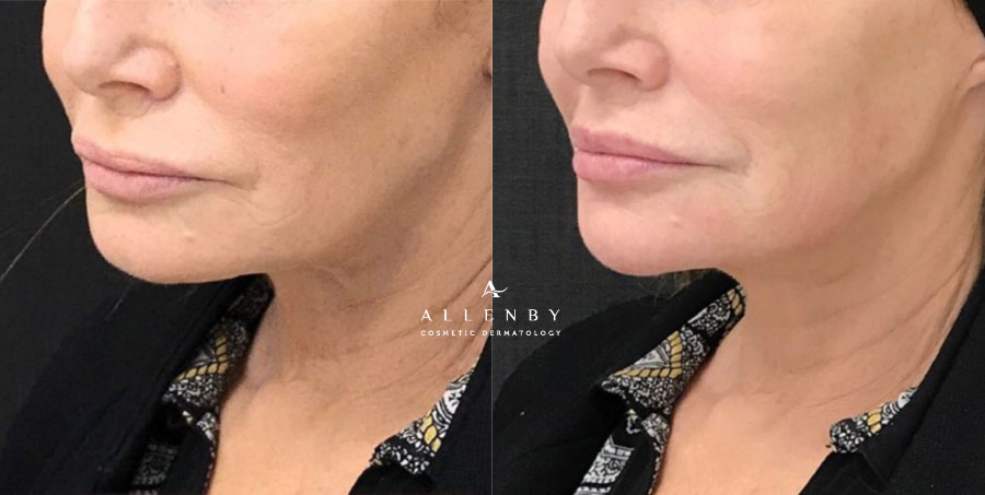 Chin Filler, Jaw Line Filler Before and After Photo by Allenby Cosmetic Dermatology in Delray Beach, FL