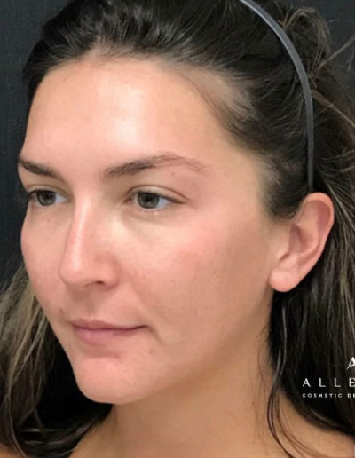 Threadlift, Jaw line and Cheek filler Before Photo by Dr. Janet Allenby in Delray Beach, FL