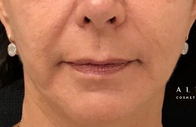 Thread Lip Lift Before Photo by Dr. Janet Allenby in Delray Beach, FL