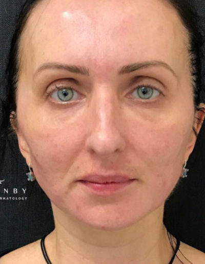 Versa Lips and Sculptra After Photo by Dr. Janet Allenby in Delray Beach, FL