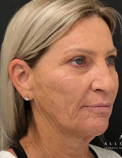 Cheek and Jaw Line Filler Before Photo by Dr. Janet Allenby in Delray Beach, FL