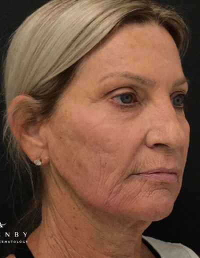 Cheek and Jaw Line Filler After Photo by Dr. Janet Allenby in Delray Beach, FL