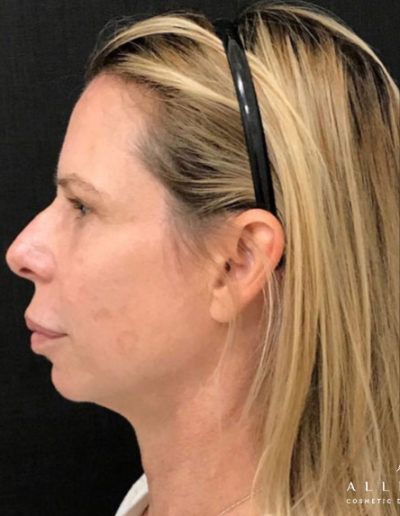 Chin and Jaw Line Filler Before Photo by Dr. Janet Allenby in Delray Beach, FL