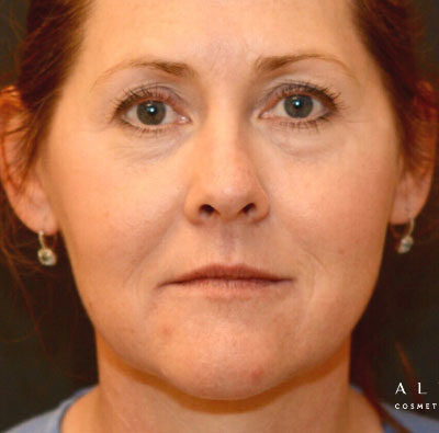 Kybella Under Eye Before Photo by Dr. Janet Allenby in Delray Beach, FL