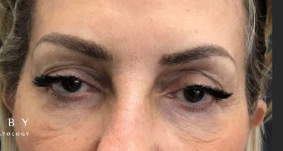 Microblading After Photo by Dr. Janet Allenby in Delray Beach, FL