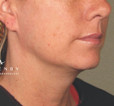 Ultherapy After Photo by Dr. Janet Allenby in Delray Beach, FL